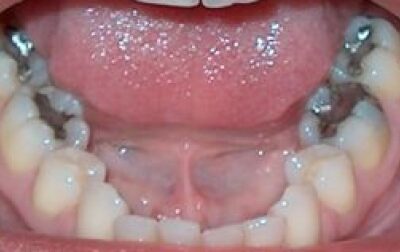 Amalgam removal