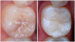 fissure sealants