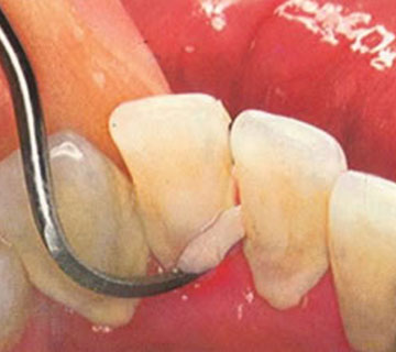 gum-disease