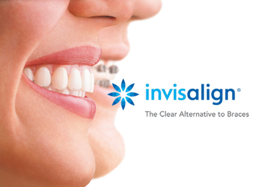 invisalign-header